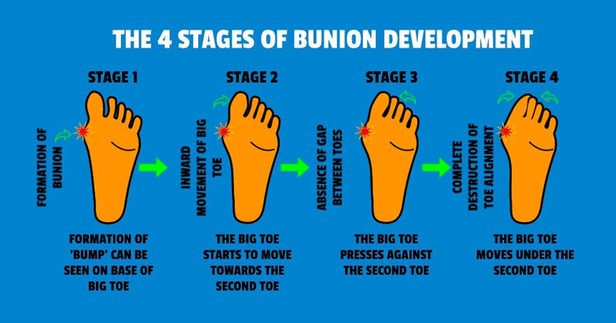 4 Stages of Bunion Development